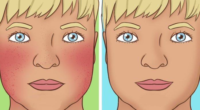 Rosacée : 8 façons naturelles pour diminuer sa présence selon Remedy Daily