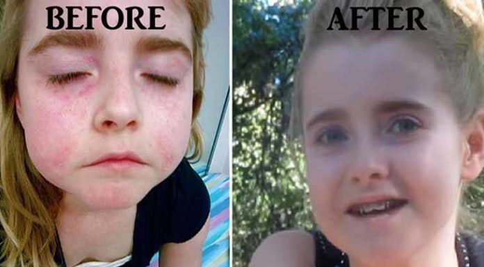 Une jeune fille a vaincu l’arthrite et le lupus en enlevant ces trois choses de son alimentation
