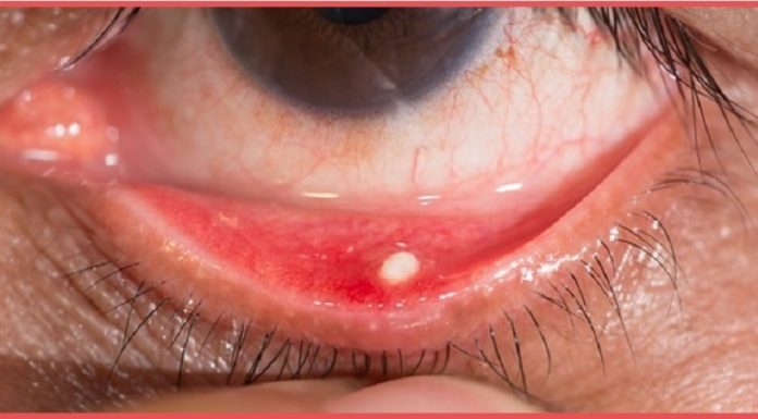 Quelles sont les causes de la conjonctivite et quoi faire pour la soigner?