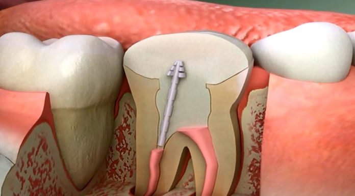 Si votre dentiste vous propose un traitement de canal vous devez refuser pour cette raison précise