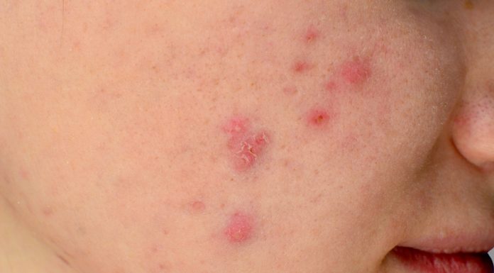 Fesses, menton ou poitrine? Lorsque l’acné en dit plus sur votre corps que vous ne le croyez!